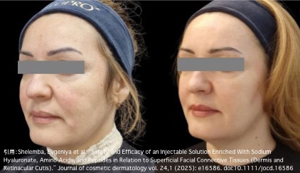 ジャルプロ スーパーハイドロ 施術イメージ