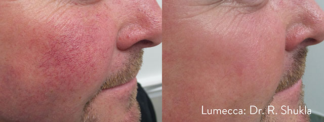 赤ら顔・赤みの改善