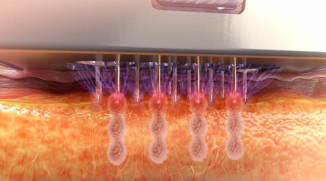 マイクロニードルによる創傷