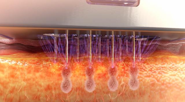 マイクロニードルによる創傷