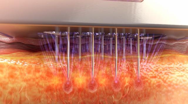 マイクロニードルによる創傷