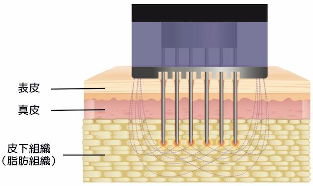 マイクロニードルによる創傷