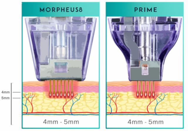 マイクロニードルによる創傷