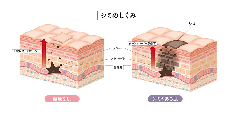 しみの原因